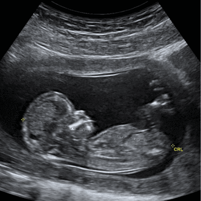 আল্ট্রাসোনোগ্রাফি